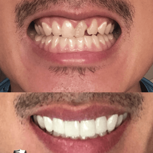 Lente Dental White® 100% ajustável - [50% OFF + FRETE GRATIS] - izistore