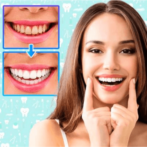 Clareador Dental Alpha Plus™ - [40% OFF + FRETE GRATIS HOJE] - izistore