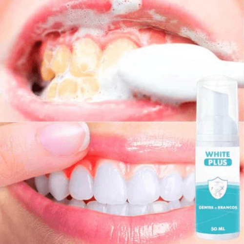 Clareador Dental Alpha Plus™ - [40% OFF + FRETE GRATIS HOJE] - izistore