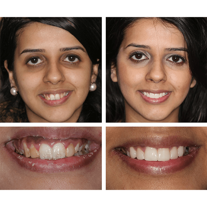 Caneta Clareadora Dental Clean® - [49% OFF + FRETE GRÁTIS] - izistore